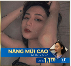 ĐỐ EM ĐOÁN ĐƯỢC? Hóa mũi tẹt thành mũi cao trong bao lâu?