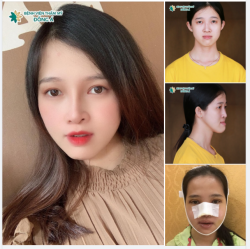 Đợi hơn 28 năm để thay đổi "Phẫu thuật hàm là điều đúng đắn nhất em lựa chọn." - Hoàng Thảo chia sẻ.