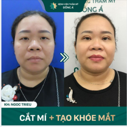 Đôi mắt to tròn, nếp mí đều, sắc nét, hài hòa chỉ sau 10 ngày Cắt mí Natural Eyes + Tạo khóe tại nhà Đông Á