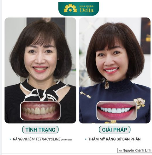 Đối với cung răng đều nhưng nhiễm tetra, thẩm mỹ răng sứ bán phần vẫn là lựa chọn tốt nhất!