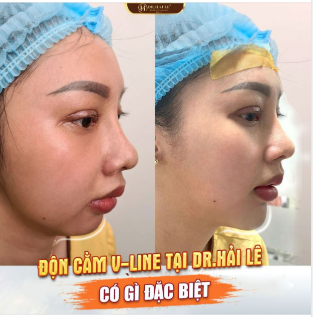 ĐỘN CẰM V-LINE TẠI DR.HẢI LÊ CÓ GÌ ĐẶC BIỆT?