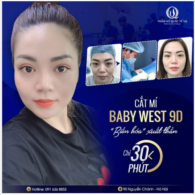 Đột phá sau khi cắt mí Baby West 9D, KH đã sở hữu nếp mí cân đối, mềm mại, đẹp tự nhiên và thanh thoát, giúp nhan sắc trẻ trung vượt bậc.