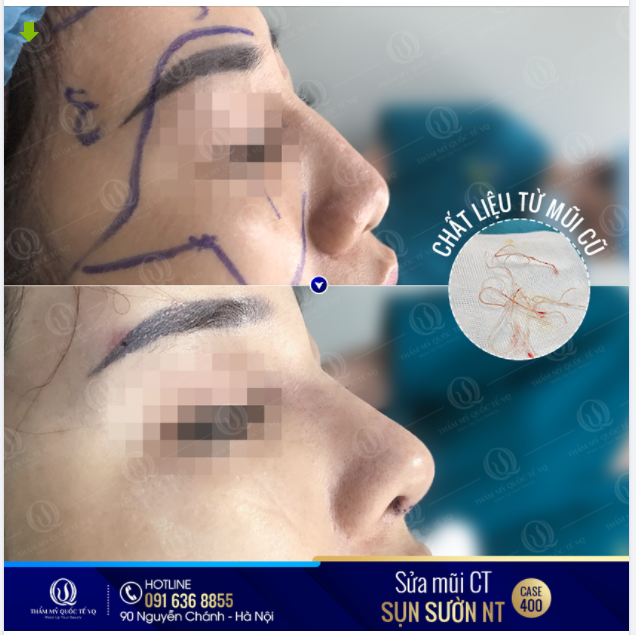 Dr Vũ Quang giải cứu mũi từng nâng bằng chỉ tại cơ sở thẩm mỹ không uy tín với tình trạng mũi: