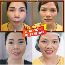 DR.HẢI LÊ QUYẾT TÂM GIẢI CỨU BẰNG ĐƯỢC CÁC CA MÍ LỖI HỎNG SAU PTTM MẮT THẤT BẠI