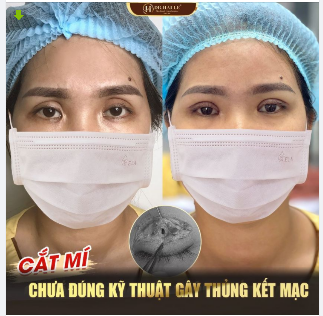 Dr.Hải Lê tiếp nhận cấp cứu ca Cắt mí sai kỹ thuật dẫn đến Thủng kết mạc