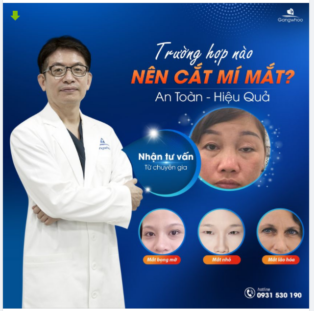 DR.PARK SUNG YONG MÁCH BẠN: TRƯỜNG HỢP NÀO NÊN CẮT MÍ MẮT 