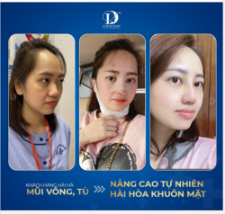 "Đúng là thay dáng mũi là thay cả khuôn mặt, mũi em 7 ngày cũng không còn bầm tím gì, ưng lắm bác sĩ ạ" - Hà chia sẻ sau nâng mũi.