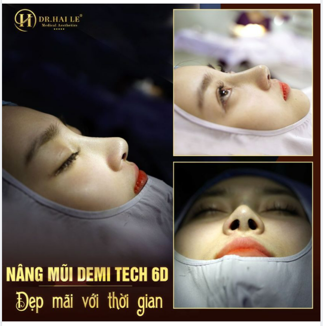 Em hiếm khi nói Say Yes với người khác. Nhưng chắc chắn đối với NÂNG MŨI DEMI TECH6D, em không thể "Say No"