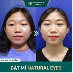 Em không thể biến 1 mí thành 2  Vậy mời em đến BVTM Đông Á