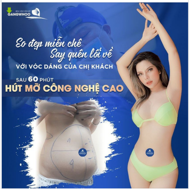 EO ĐẸP MIỄN CHÊ - SAY QUÊN LỐI VỀ VỚI VÓC DÁNG CỦA CHỊ KHÁCH SAU KHI THỰC HIỆN HÚT MỠ CÔNG NGHỆ CAO