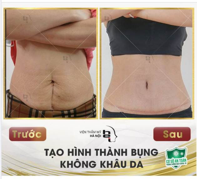 EO PHẲNG BỤNG THON - CHI PHÍ MI NHON !