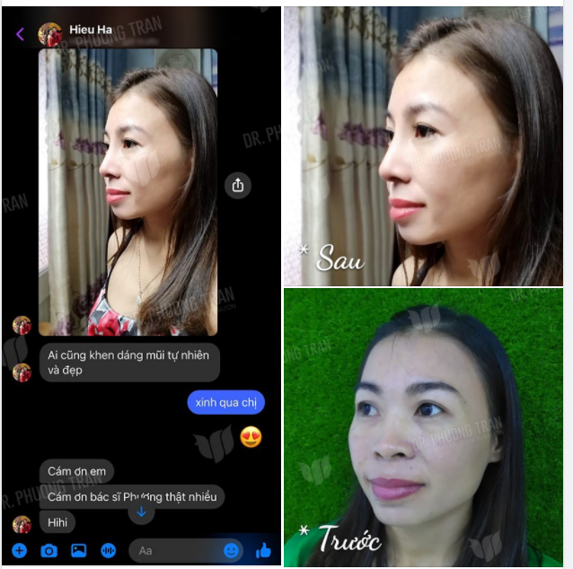 FEEDBACK SAU HƠN 1 THÁNG NÂNG MŨI SỤN SƯỜN