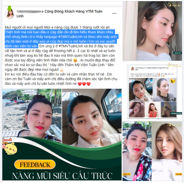 FEEDBACK "SIÊU SỊN" CỦA KHÁCH HÀNG NHÀ TUẤN LINH SAU NÂNG MŨI SIÊU CẤU TRÚC.