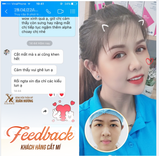 Feedback từ khách hàng nhà Xuân Hương sau khi Cắt Mí Mắt Mini Deep.
