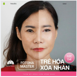 FOTONA MASTER - TRẺ HÓA XÓA NHĂN TỨC THÌ