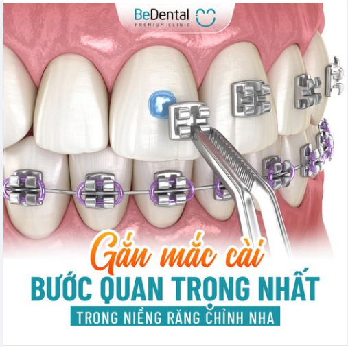 Gắn mắc cài - bước quan trọng nhất trong niềng răng chỉnh nha - Tại sao vậy?