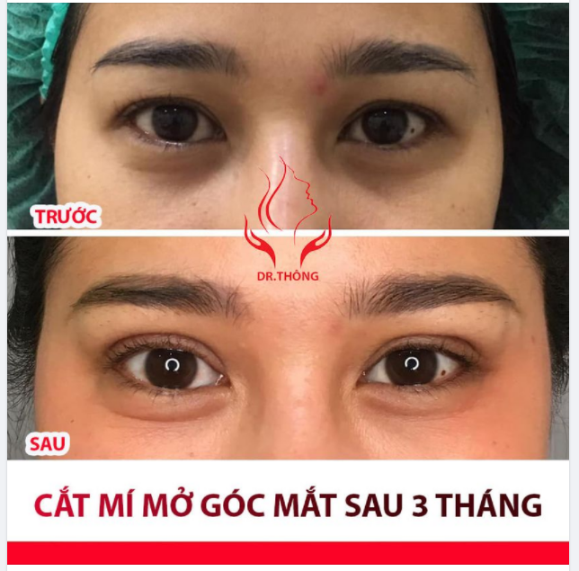 GẶP LẠI CHỊ KHÁCH TÁI KHÁM CẮT MÍ + MỞ GÓC TRONG SAU 3 THÁNG