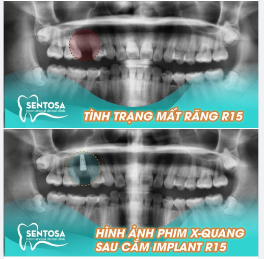 GIẢI PHÁP BỀN VỮNG CHO MẤT RĂNG CHỈ CÓ THỂ LÀ “CẮM IMPLANT”