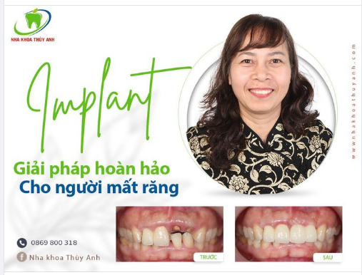 GIẢI PHÁP NÀO CHO RĂNG CỬA MẤT