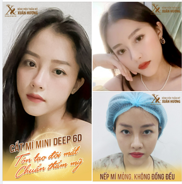 GIẢI PHÁP Tối Ưu với từng tình trạng: 1 Mí, Mí Lệch, Bọng Mỡ, Da Chùng, Sụp Mí.