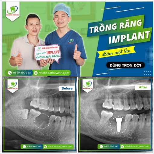 GIẢI PHÁP TRỒNG RĂNG TIẾT KIỆM  Trọn gói chỉ 6 triệu 9