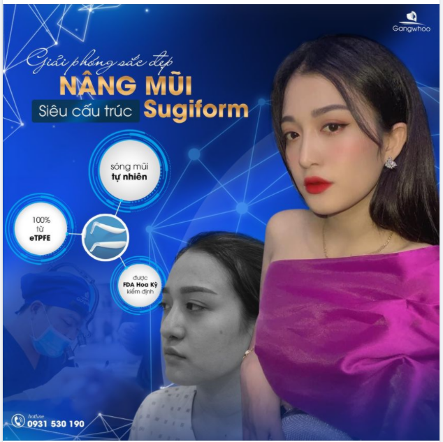 GIẢI PHÓNG SẮC ĐẸP CÙNG MŨI SURGIFORM