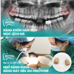 GIẢI THOÁT CHO NHỮNG ÁC MỘNG RĂNG KHÔN