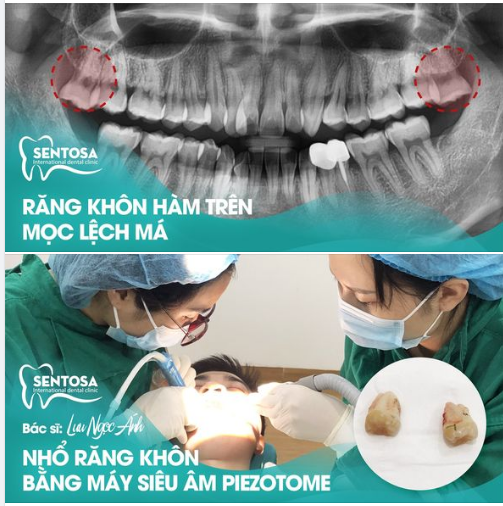 GIẢI THOÁT CHO NHỮNG ÁC MỘNG RĂNG KHÔN