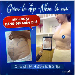 GIẢM LÀ ĐẸP - NHÌN LÀ MÊ NGAY VÒNG 2 CỦA CHỊ M.H SAU KHI DÙNG HÚT MỠ (CÔNG NGHỆ CAO LIPO ULTRASOUND)