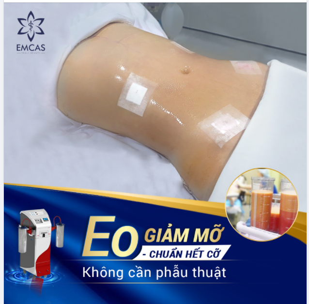 GIẢM MỠ AN TOÀN, TRÚNG ĐÍCH CÙNG “SIÊU PHẨM” LIPOMATIC