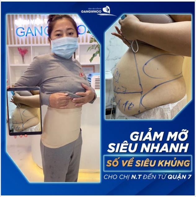 GIẢM MỠ SIÊU NHANH - SỐ VỀ SIÊU KHỦNG CHO CHỊ N.T ĐẾN TỪ QUẬN 7