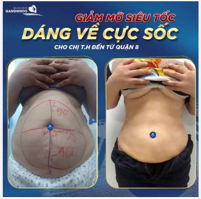 GIẢM MỠ SIÊU TỐC - DÁNG VỀ CỰC SỐC CHO CHỊ T.H ĐẾN TỪ QUẬN 8
