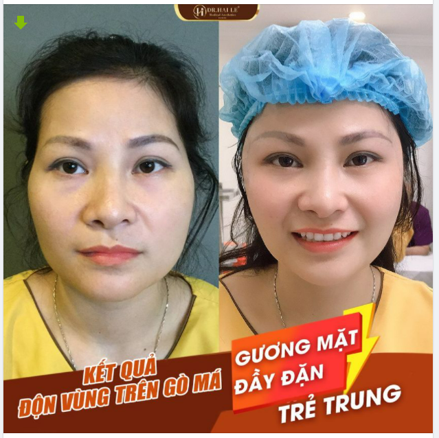 Gương mặt đầy đặn, trẻ trung hơn chỉ sau 45 phút thực hiện phẫu thuật Độn vùng trên gò má.!!
