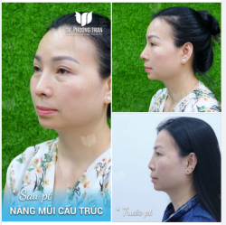 GƯƠNG MẶT KHÁC RÕ NHỜ ĐỔI DÁNG MŨI