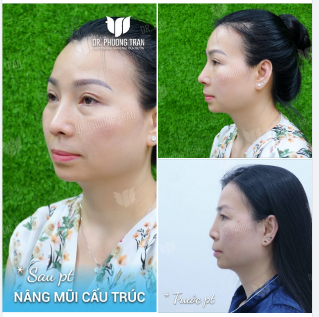 GƯƠNG MẶT KHÁC RÕ NHỜ ĐỔI DÁNG MŨI