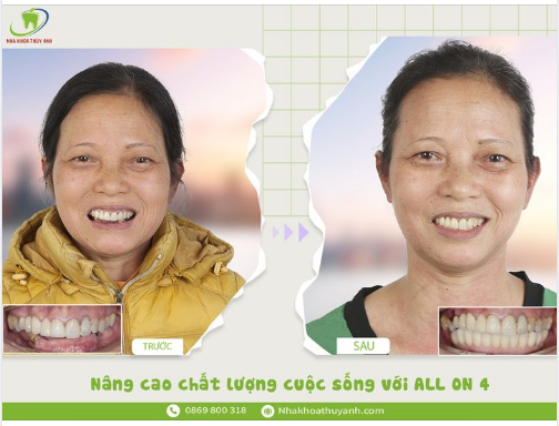HÀM GIẢ ALL ON 4 GIÚP HỒI XUÂN CHO HÀM RĂNG THẬT ĐÃ MẤT LÂU NĂM