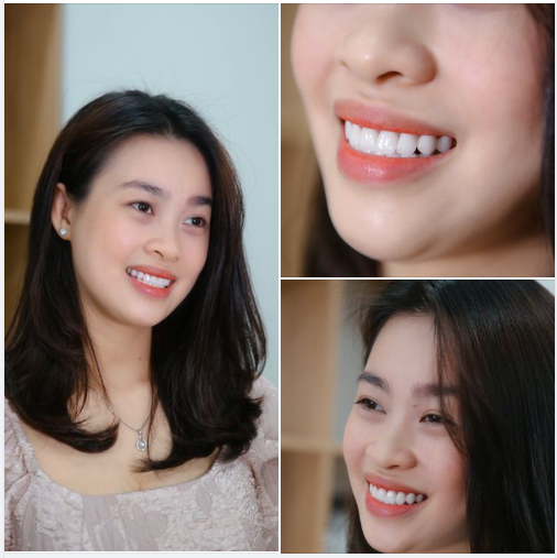 HÀM RĂNG ĐẸP THẾ NÀY ĐỦ THUYẾT PHỤC BẠN ĐẾN NHA KHOA GIA ĐÌNH CHƯA