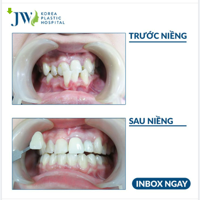HÀNH TRÌNH TÌM LẠI NỤ CƯỜI, NIỀNG RĂNG KHIẾN BẠN THAY ĐỔI NHƯ THẾ NÀO?