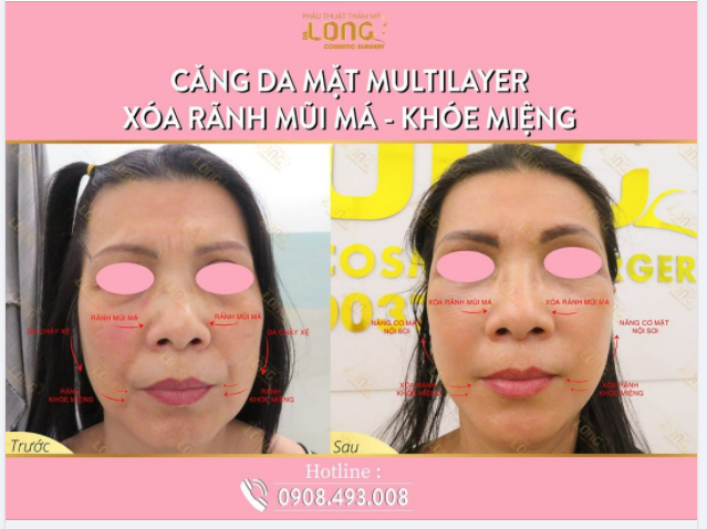 HÃY BẤM VÀO XEM NẾU BẠN MUỐN: “DA SẠCH NHĂN -TĂNG TUỔI TRẺ”
