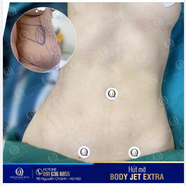 HÈ ĐẾN RỒI - HÚT MỠ THÔI