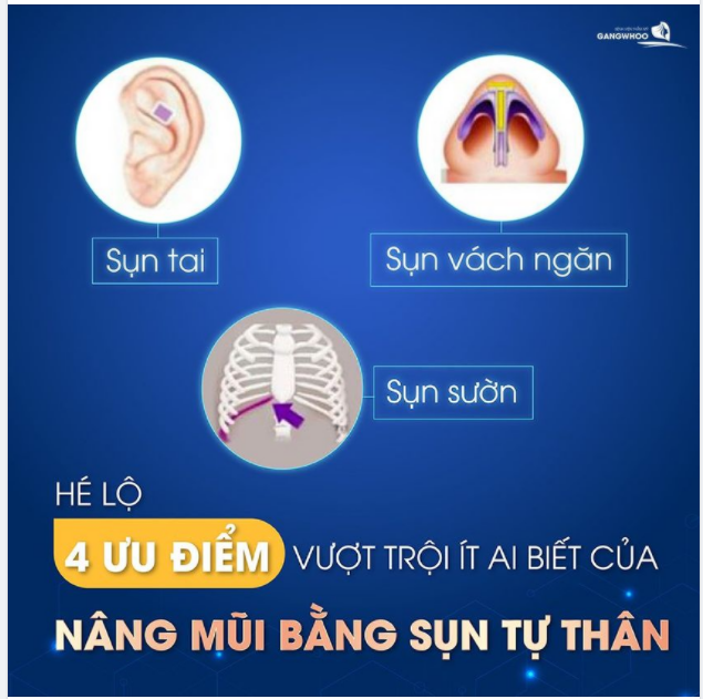 HÉ LỘ 4 ƯU ĐIỂM VƯỢT TRỘI CỦA NÂNG MŨI BẰNG SỤN TỰ THÂN