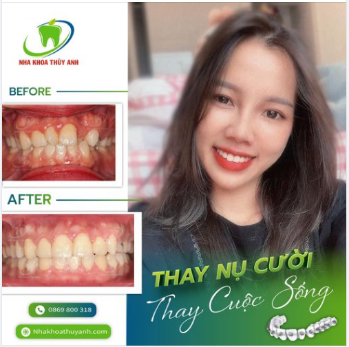 HÈ SÔI ĐỘNG NIỀNG RĂNG TRẢ GÓP LÃI SUẤT 0%