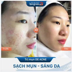 Hè về, nhiều hoa quả nóng, càng ăn càng nổi mụn
