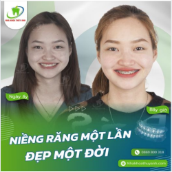 HẾT NGAY MÓM MÀ RĂNG KHỎE MẠNH CHỈ SAU 6 THÁNG