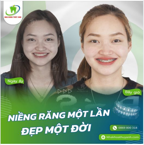 HẾT NGAY MÓM MÀ RĂNG KHỎE MẠNH CHỈ SAU 6 THÁNG
