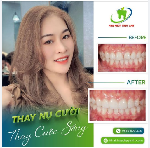 HẾT THƯA - HẾT SỨT MẺ CHỈ SAU MỘT LẦN THỰC HIỆN