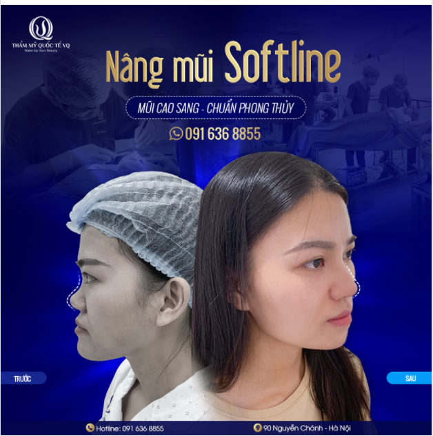 Hình ảnh trước và sau thay đổi ngoạn mục của chị KH là minh chứng rõ nhất cho dáng mũi Softline chưa làm ai thất vọng của Bs Vũ Quang