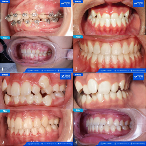 HÔ, MÓM, RĂNG LỆCH LẠC HOẶC KẾT HỢP NHIỀU VẤN ĐỀ