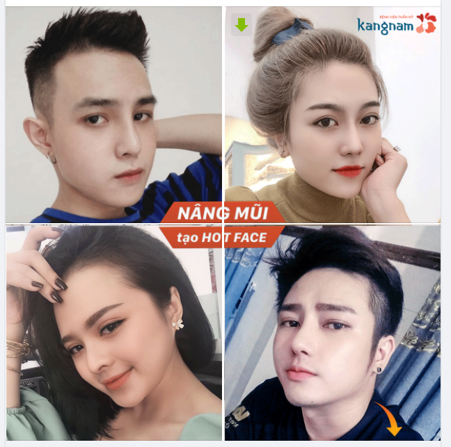 Hóa Hot Face chỉ nhờ Nâng mũi