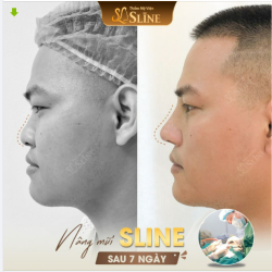 "HOÁ NAM THẦN ĐẸP TRAI" NHỜ NÂNG MŨI SLINE